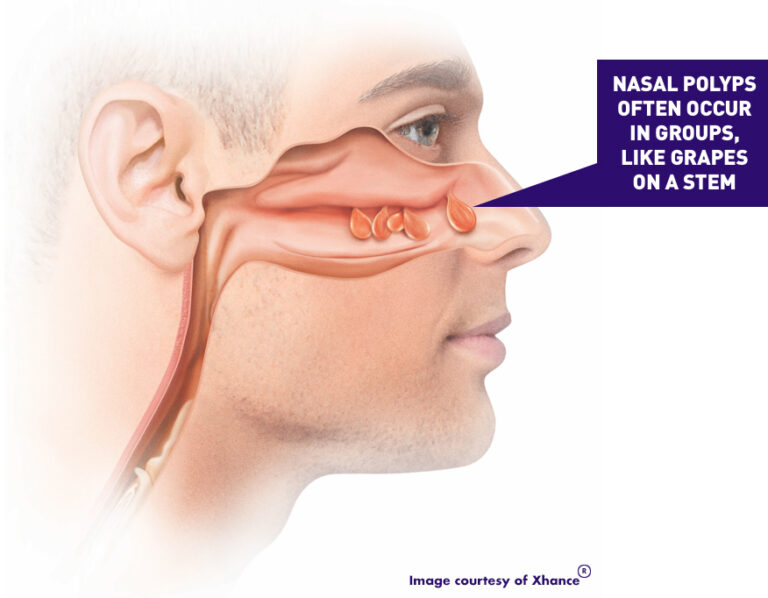 Nasal Polyps